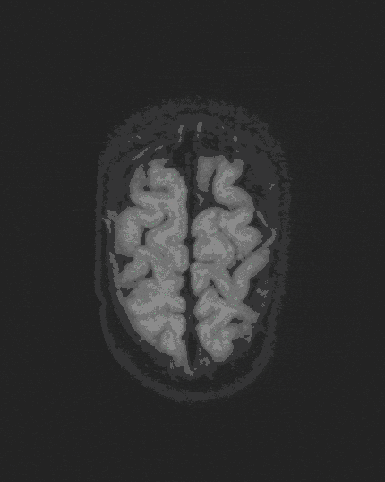 Kraniosynostosen Kraniosynostosen